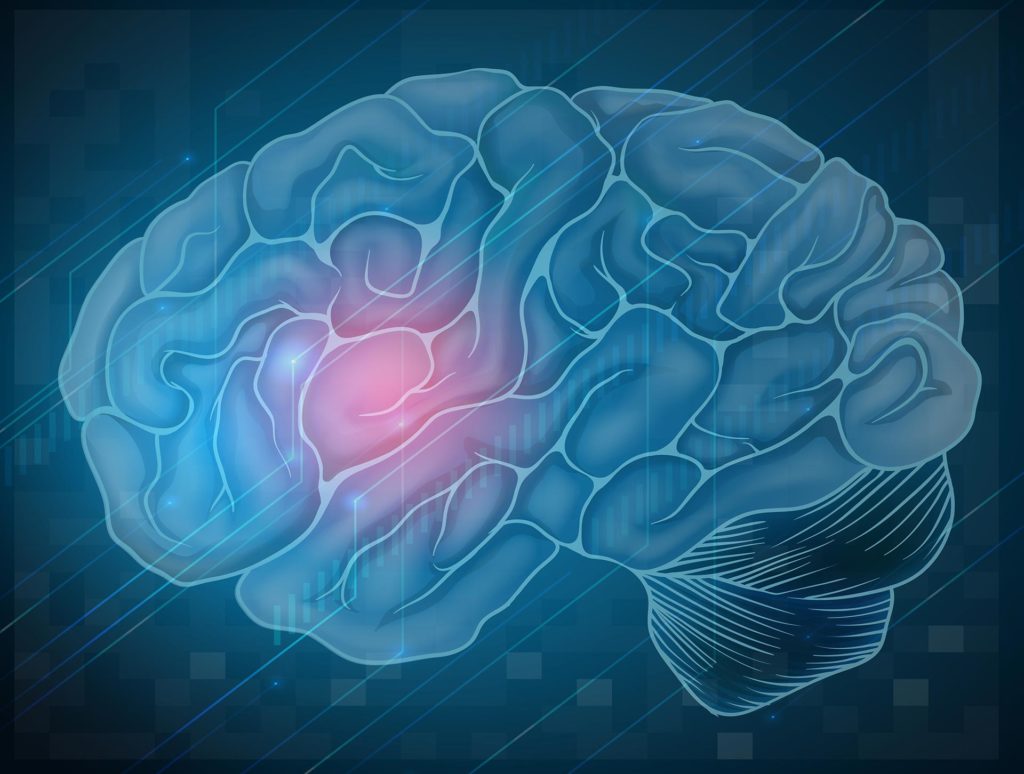 brain-stroke